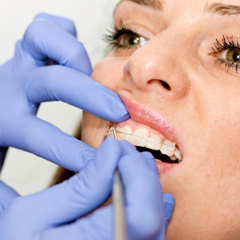 Ortodoncia brackets esteticos murcial clinica dental ortoperio