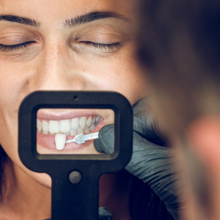 Carillas Dentales lanchares renteria y san sebastian