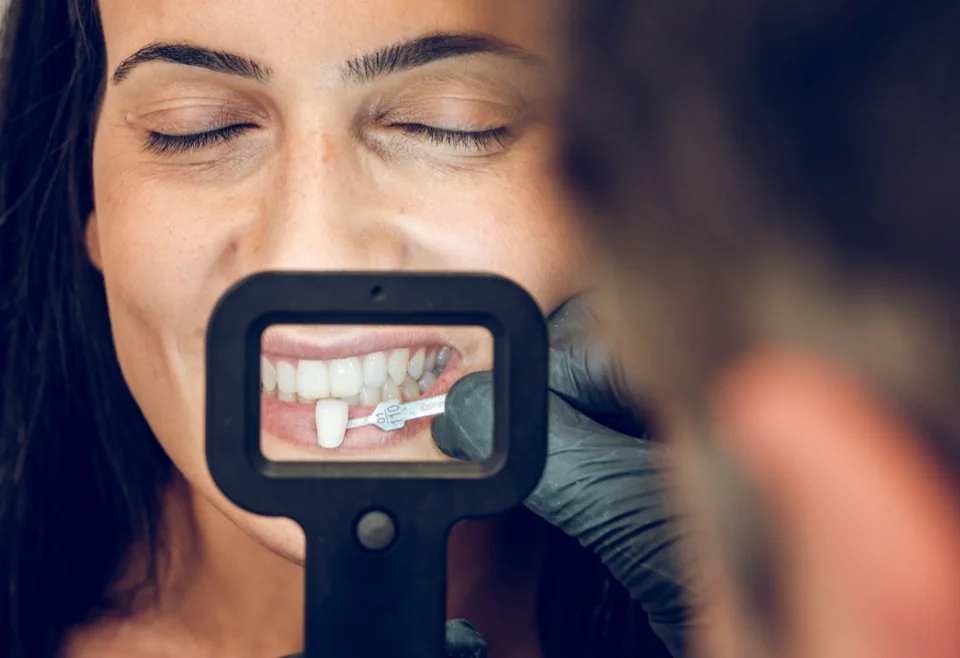 Carillas Dentales · Lanchares Dental